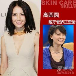 女明星矫正牙齿图片,揭秘女明星矫正牙齿前后对比